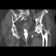 Rectovaginal fistula: CT - Computed tomography